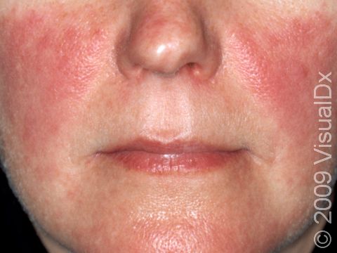 The dull red patches of systemic lupus are prominent in sun-exposed areas. When these patches are seen on the cheeks, one can imagine why the term 