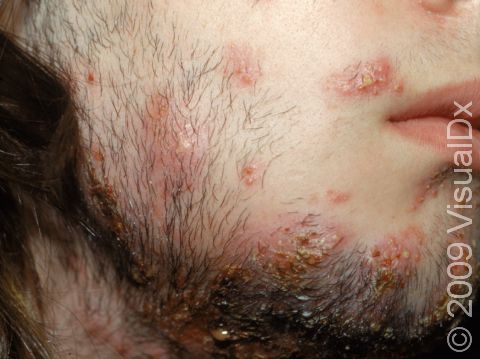 This case of tinea barbae (a fungal infection of the beard area) has pus-filled lesions with crusting.