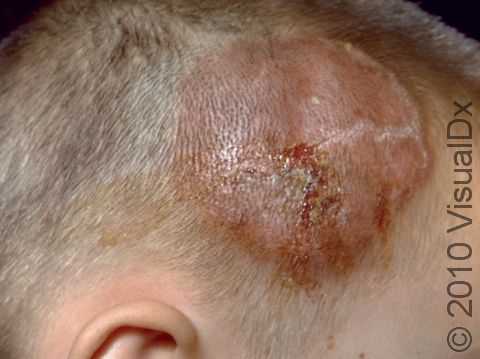 Tinea capitis (fungal scalp) infections can have crusts, scale, and cause hair loss.