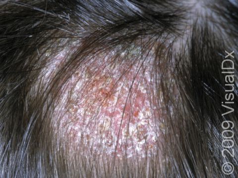 This image displays round, scaly, slightly elevated areas on the scalp typical of tinea capitis.