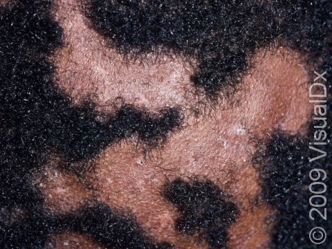 In a person with hair loss and scale on the scalp, fungal infection may be the cause.