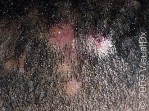 In tinea capitis, there can be many areas of hair loss, as displayed in this image.