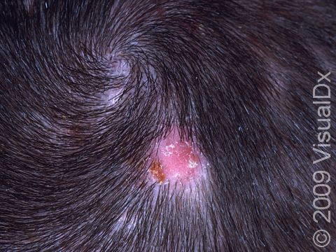 Tinea capitis (a fungal scalp infection) typically has round areas of hair loss with scaling and redness of the scalp.