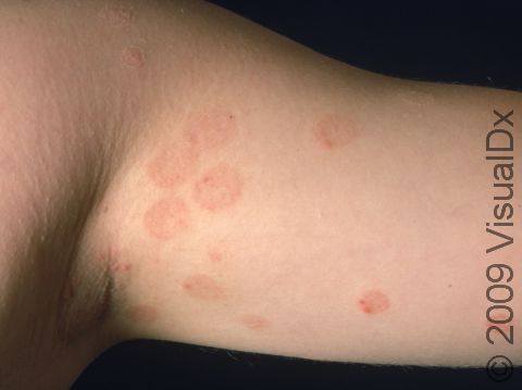 This image displays the red, circular lesions typical of tinea corporis (ringworm).