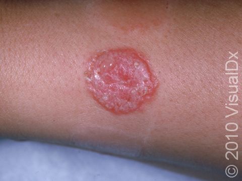 This image displays the common round shape of tinea corporis that has been covered with a bandage, thus causing it to appear red and moist.