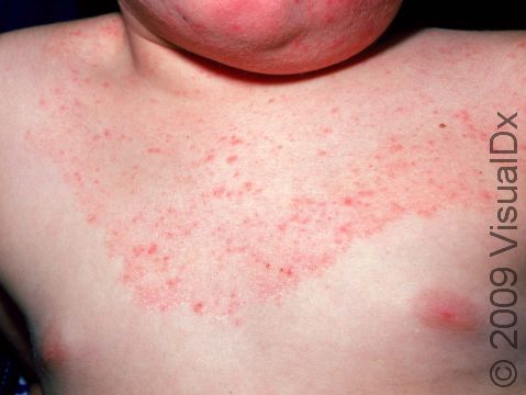 This image displays tinea (ringworm), which can be widespread with slight scaling and a relatively sharp edge to the area of involvement.