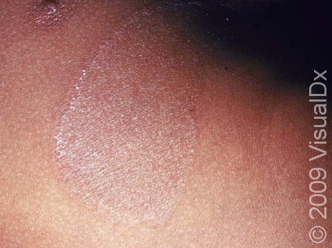 This image displays the round shape with a scaling, bumpy edge typical of tinea (ringworm).