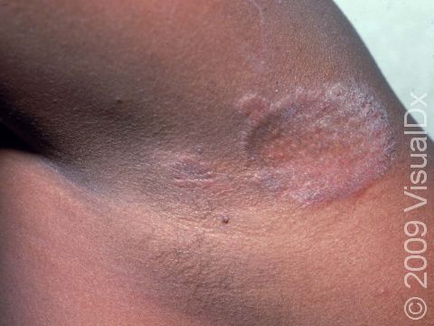 This image displays an armpit affected with tinea (ringworm).