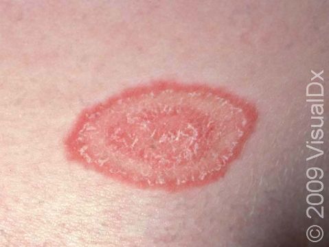 Tinea often causes scaly, round rings with sharp borders.