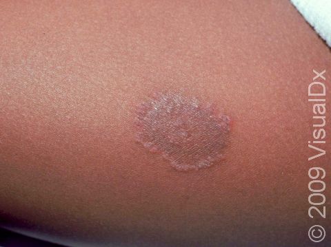 This image displays the scaly border with other smooth, slightly elevated regions typical of tinea corporis (ringworm).
