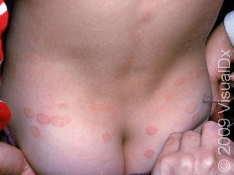 In superficial fungal infections of the skin (tinea corporis), there can be many separate scaly areas of involved skin.