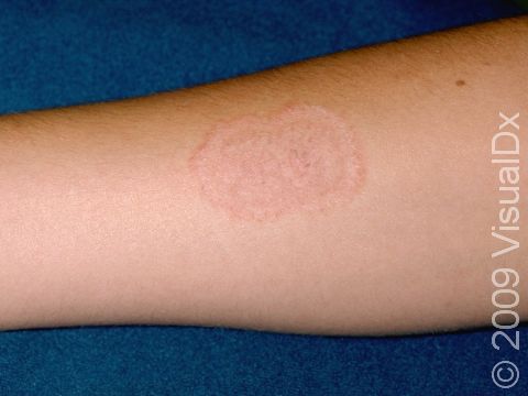 This image displays a red, scaly, ring-like lesion typical of tinea corporis.