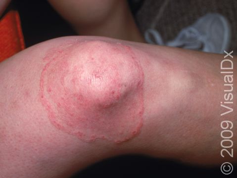 This image displays scaly, red skin areas forming rings typical of the fungal infection of the skin known as tinea corporis.
