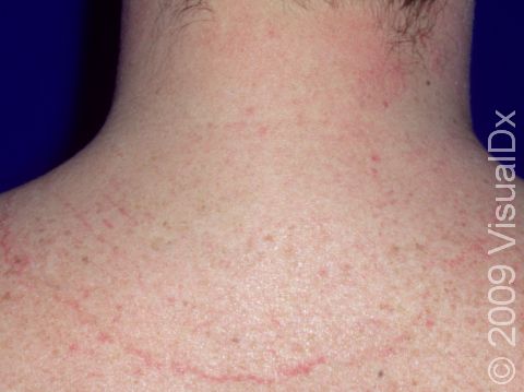 This image displays a large, subtle circle of tinea (ringworm) with a red, bumpy border, as well as another smaller circle of infection near the hairline on the picture's right.