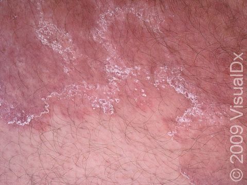 The scale in tinea corporis is often very fine and seen at the outer edge of the areas of involvement.
