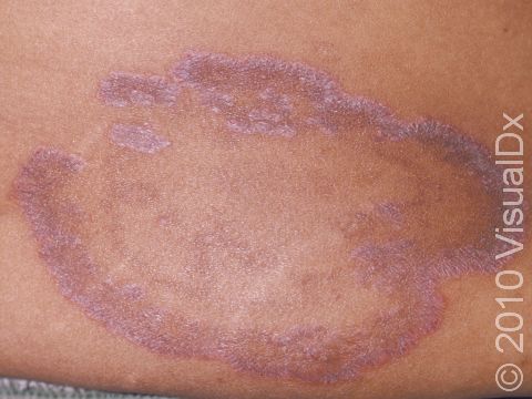 Tinea corporis often has large ring-like, scaly lesions.