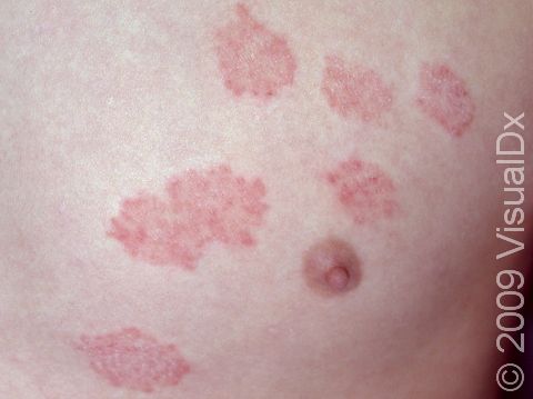 This image displays red, scaly, raised lesions of tinea corporis; these particular lesions are not in their usual ring-shaped form.