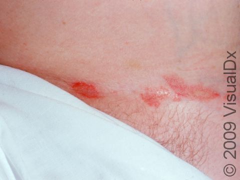 This image displays the small areas of scaly redness typical of a mild case of tinea cruris (jock itch).