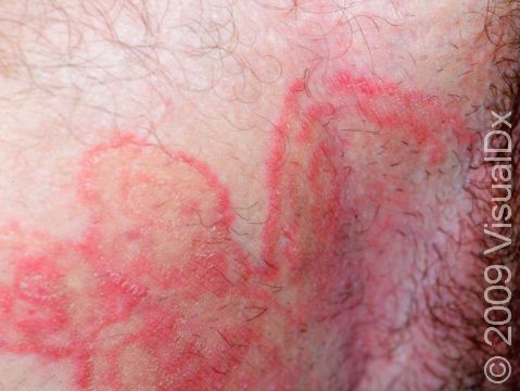 Numerous rings of tinea may intersect, causing unusual patterns, as displayed in the groin of this individual.