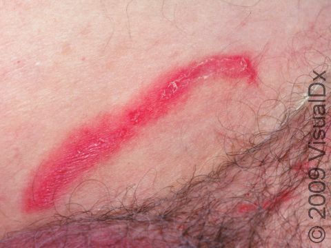 In addition to itching, redness, and swelling, tinea cruris (jock itch) usually has areas of scaling at the edges, as displayed in this image.