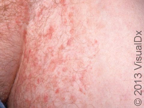 Tinea cruris is the medical term for 