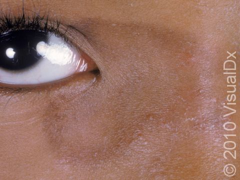This image displays round, sharply bordered areas typical of tinea faciale.