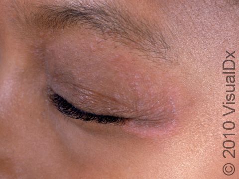 This image displays the outside of an eye area with a circular, scaling, pink patch due to tinea (ringworm).