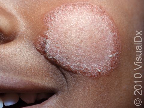 This image displays the round shape and pink, bumpy border of tinea on the face (ringworm).