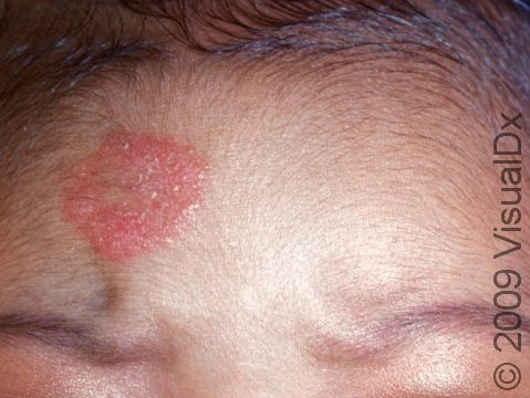 Tinea (superficial fungal infections of the skin) can occur anywhere on the body, including the face.