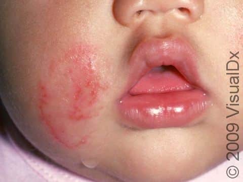 This image displays a scaly, red edge of a slightly elevated lesion typical of tinea faciale (a superficial fungal skin infection of the face).