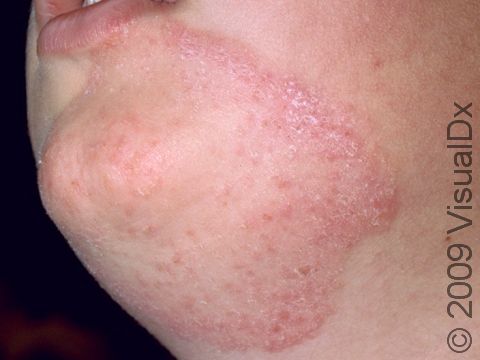 This image displays the superficial skin fungal infection of the face known as tinea faciale.