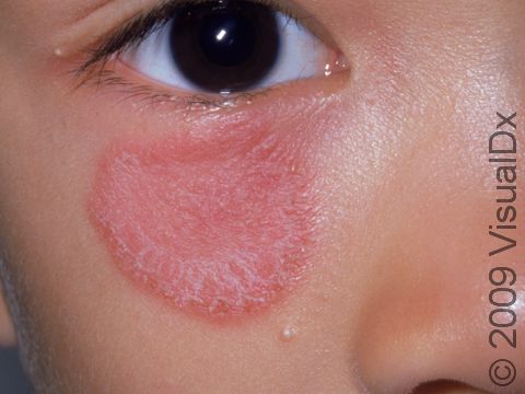 This image displays scaling and a sharp edge to the affected area typical of tinea faciale, the medical term for a skin fungus (