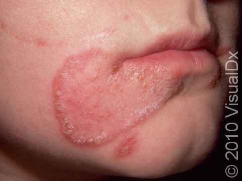 Tinea faciale (a fungal infection on the face) often has pink, ring-like, slightly elevated lesions with scaling at the edge.
