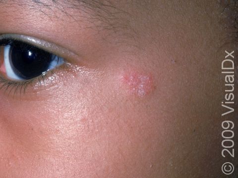 This image displays a small, slightly scaly area typical of the superficial fungal infection tinea.