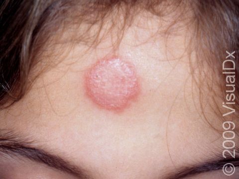 Tinea infection (ringworm) is characterized by a pink to red round, scaling patch.