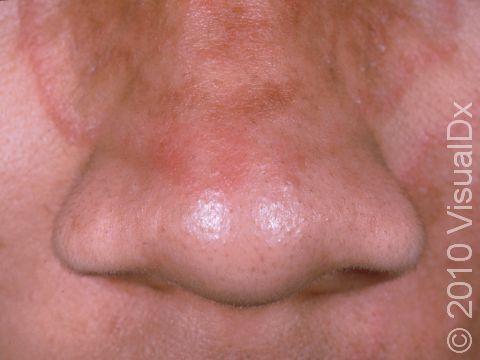 Tinea faciale, a fungal infection of the skin of the face, is displayed in this image as the arching red edge spanning from the cheek across the nose.