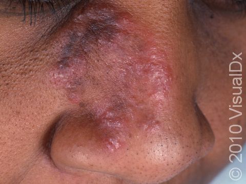 This image displays how tinea faciale (ringworm of the face) can present on dark skin.