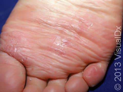 This image displays scaly, slightly elevated lesions typical of tinea pedis (athlete's foot).
