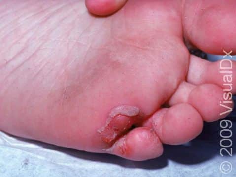 The space between the 4th and 5th toe is a frequent location of the start of athlete's foot (tinea pedis).