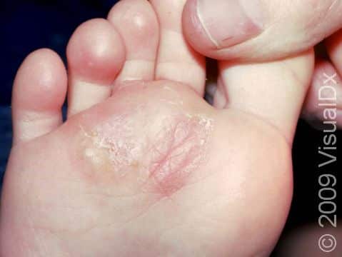 This image displays tinea (athlete's foot) on the bottom area of the foot creeping toward the space between the second and third toes.