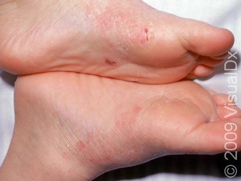 This image displays red, scaly patches on the instep soles typical of tinea pedis (athlete's foot).