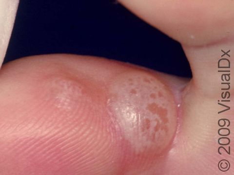 Athlete's foot (tinea pedis) can cause blisters, such as this case between the toes.