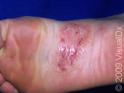 Tinea pedis (athlete's foot) can cause blisters, as displayed in this scaly, red patch.