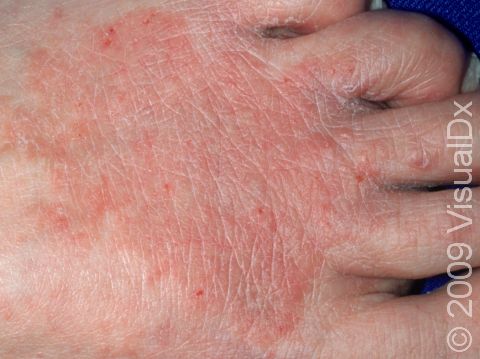 The circular shape of this red, scaling area of skin on the back of the foot demonstrates why tinea is often called 