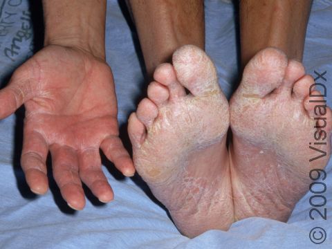 This image displays two feet-one hand syndrome that is typical in tinea pedis (athlete's foot), with both feet and only one hand being affected.