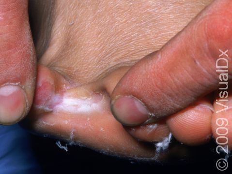 Tinea pedis (athlete's foot) will often start between the toes, as displayed in this image.
