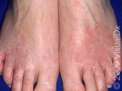 The circular shape of these red, scaling patches on the back of the feet demonstrate why tinea is often called 