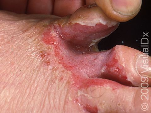 This image displays scaling and erosion of the skin between the toes in a severe case of tinea pedis (athlete's foot).