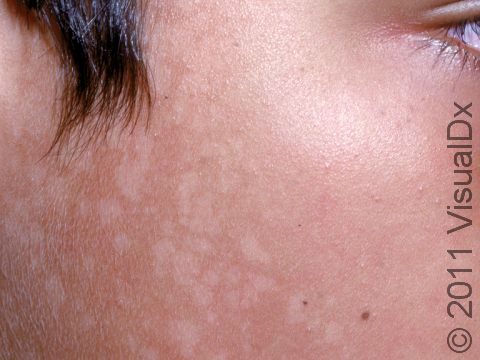 This image displays tinea versicolor on the face.