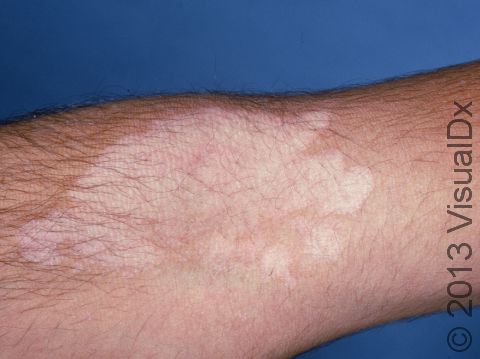 This image displays a typical location of tinea versicolor, the bend in the elbow.